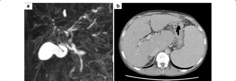 The Imaging Findings Of Primary Sclerosing Cholangitis Psc Are Shown