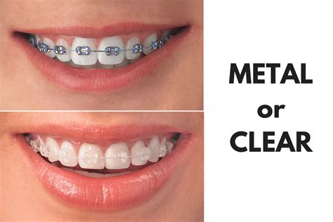 General dentistry problems will also be explained. Ask Your Fort Worth Dentist: Should I Get Metal or Clear ...