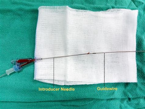 Stuck Guidewire Due To Soft Tissue Imposition A Rare Complication Of
