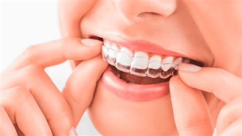 Can Invisalign Fix Overbites Cosmetic Dentistry Van Nuys CA