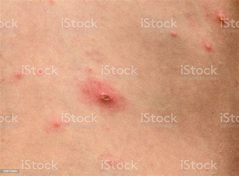 Varicella Zoster Virus Or Chickenpox Bubble Rash On Child Baby Stock