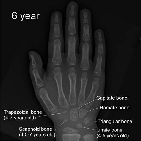 Child Hand X Ray Рентгенография МРТ КТ