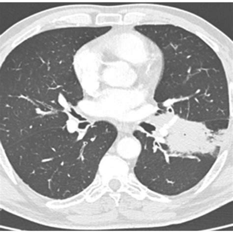 Ct Scan At Diagnosis Showing Left Lung Tumor Mass Download