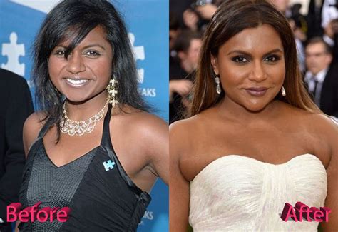 Mindy Kaling Plastic Surgery A Project Done Well