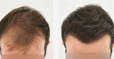 In fact, it is very good news that you have already noticed that your hair loss has slowed; Irish Times Article - Heads Up: The Many Treatments for ...