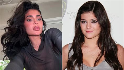 Kylie Jenner Addresses Plastic Surgery Rumours As She Opens Up On