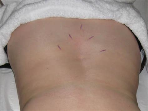 Acupuncture for back pain Tenterden