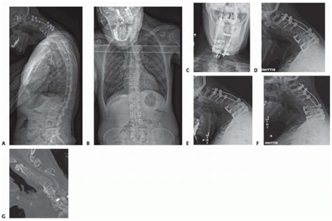 Cervical Osteotomies For Kyphosis Musculoskeletal Key