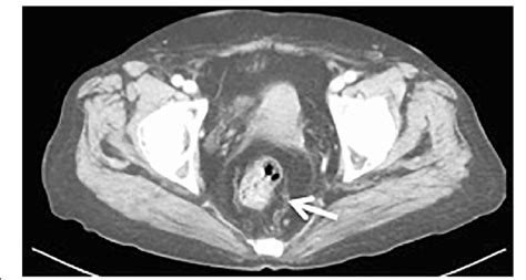 Pelvic Contrast Computed Tomography Ct Scan Showing Wall Thickening