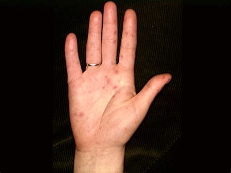 Herpes On Palm Of Hands Pictures Photos