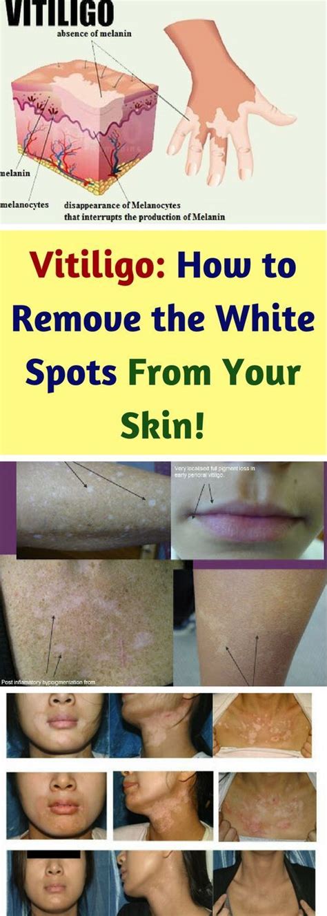 Vitiligo How To Remove The White Spots From Your Skin Health At Home