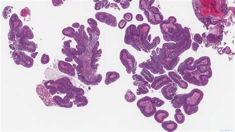 Papillary Squamous Cell Carcinoma Of The Larynx Atlas Of Pathology