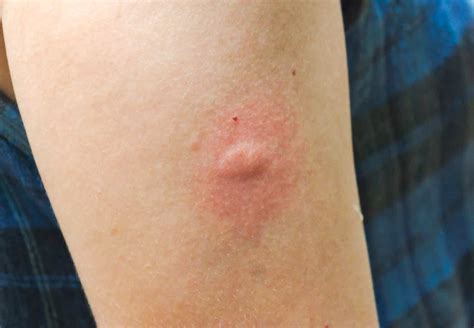 Mosquito Bites On Humans Pictures Tips Nextgen Pest Solution
