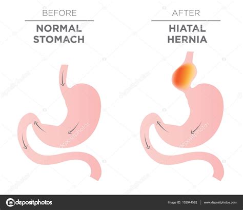Hiatus Hernia Hiatal Hernia Types Of Hiatal Hernia Illustration Stock