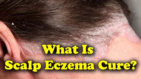 Eczema In Hair Treatment Doctor Heck