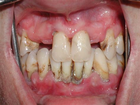 Diseases Gum Disease Pictures