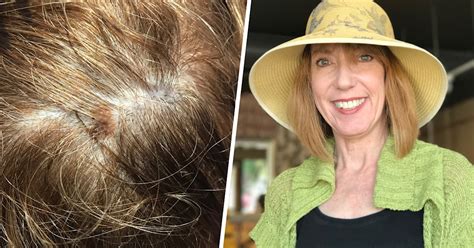 Don T Forget To Check Your Scalp For Melanoma Skin Cancer