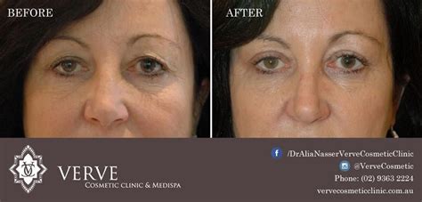 Upper Blepharoplasty Surgery Is A Procedure Performed To Correct