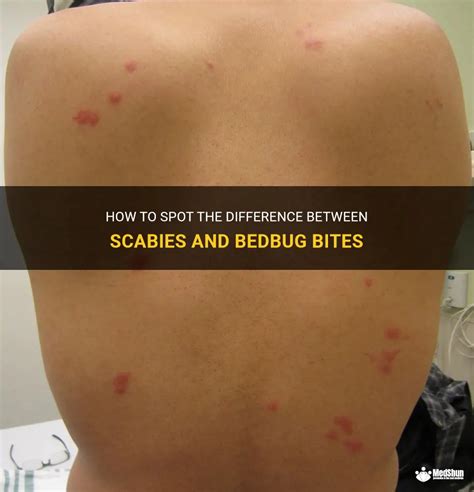 How To Spot The Difference Between Scabies And Bedbug Bites Medshun