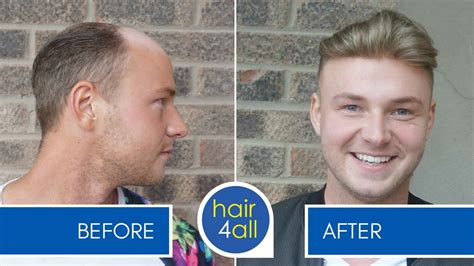 Before And After Results Of Our Non Surgical Hair Replacement System For Menwomen Youtube