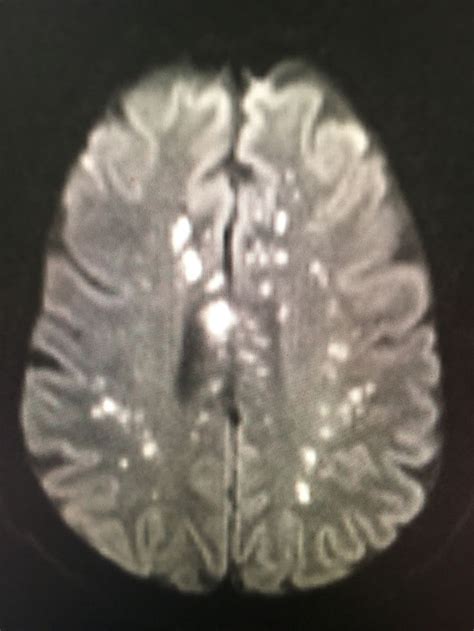 Embolic Infarcts Radiology Mri Neuro