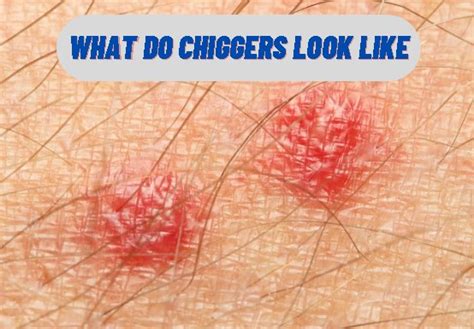 What Do Chiggers Look Like Full Guide