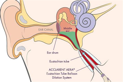 Advanced Ent Treatments Balloon Sinuplasty Baha Ear Implant