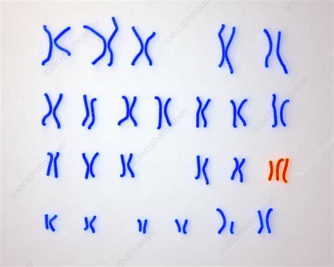Edward S Syndrome Karyotype Illustration Stock Image F