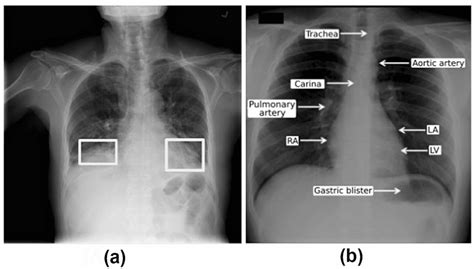 A Example Of Pulmonary Opacities B Normal Chest Radiography Showing