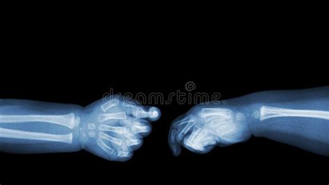 Baby S Hands X Ray And Blank Area At Upper Side Shake Hands Stock