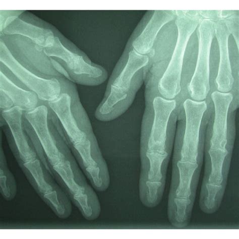 Hand Radiograph Enhanced By Using Mammography Film Showing