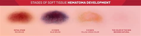 Hematoma Stages Stock Vector Illustration Of Hematoma 89377392