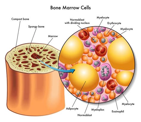 How Multiple Myeloma Of The Spine Is Diagnosed