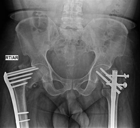 Cureus Simultaneous Bilateral Intertrochanteric Fractures Of The