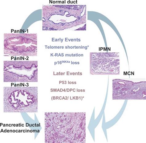 Pancreatic Precursor Lesions And Genetic Events Involved In Pancreatic