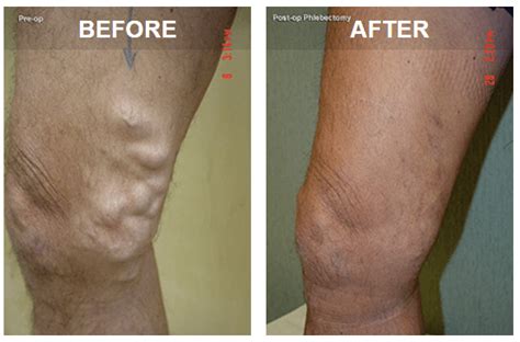 Varicose Veins Are They Dangerous Vein Specialists Of The South