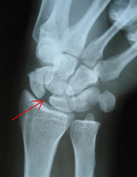 Scapholunate Ligament Injury Alaska Hand Elbow Should