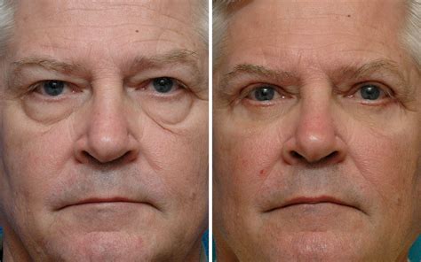 How does a blepharoplasty work? Eyelid Surgery Before & After Photos Annapolis MD