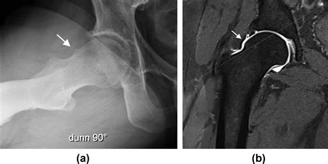 References In The Imaging Findings Of Impingement Syndromes Of The