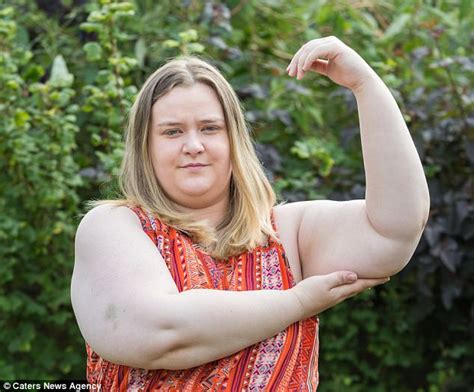 Woman With Giant Arms And Legs Pleas For 19k Daily Mail Online