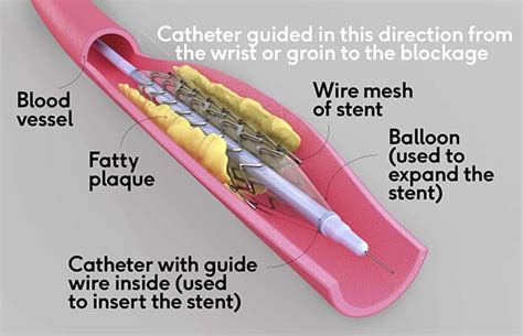 How Do Stents Work 2023
