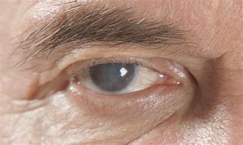 What Is Glaucoma And Why Is It Scary Surevision Eye Centers
