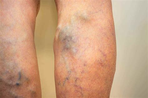 Ugly Leg Veins Treatments And Causes Vein Clinic Perth