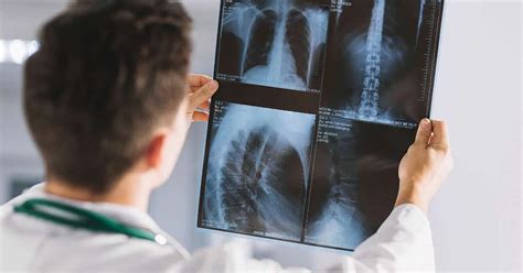 Radiografia O Que Raio X E Como Funciona O Exame
