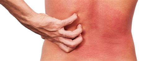 Unveiling The Power Of Detoxification In Stamford, CT, For Food Allergy