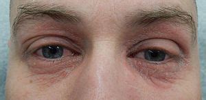 Without chlorine acting as a sanitizer, the water in your pool or hot tub would get nasty in a hurry. Periorbital dermatitis - Wikipedia