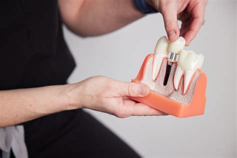 What is a Dental Implant? | CarolinasDentist | North Carolina