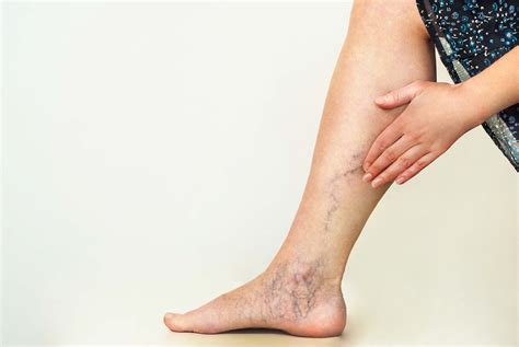 Varicose Spider Veins Causes Symptoms And Treatments
