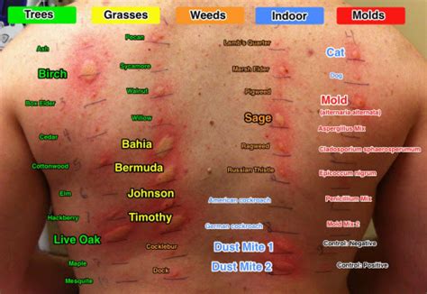 Allergy Skin Test Allergy Immunology Specialists