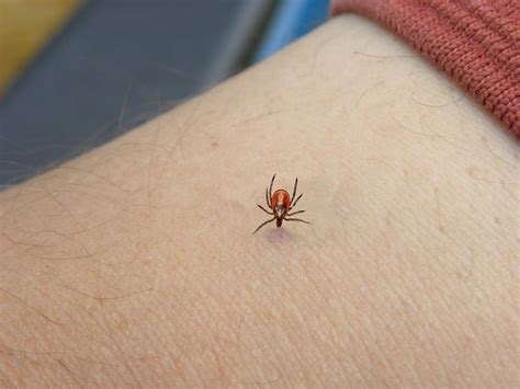How To Remove A Tick Correctly Tick Removal Tips Prevention Ph